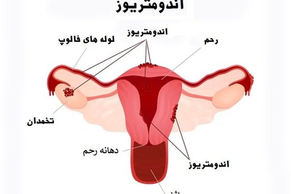 فیبروم و اندومتریوز در زنان — علائم، تشخیص و راههای درمان طبیعی و دارویی