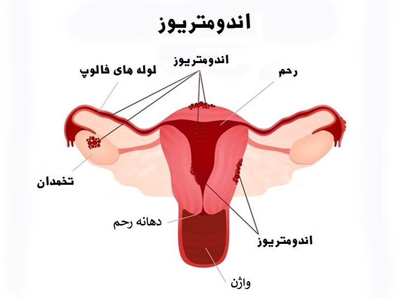 فیبروم و اندومتریوز در زنان — علائم، تشخیص و راه‌های درمان طبیعی و دارویی