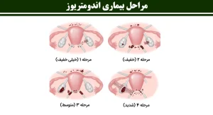 فیبروم و اندومتریوز در زنان — علائم، تشخیص و راههای درمان طبیعی و دارویی